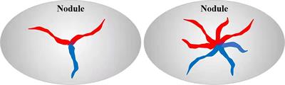 The spoke wheel color Doppler blood flow signal is a specific sign of papillary thyroid carcinoma